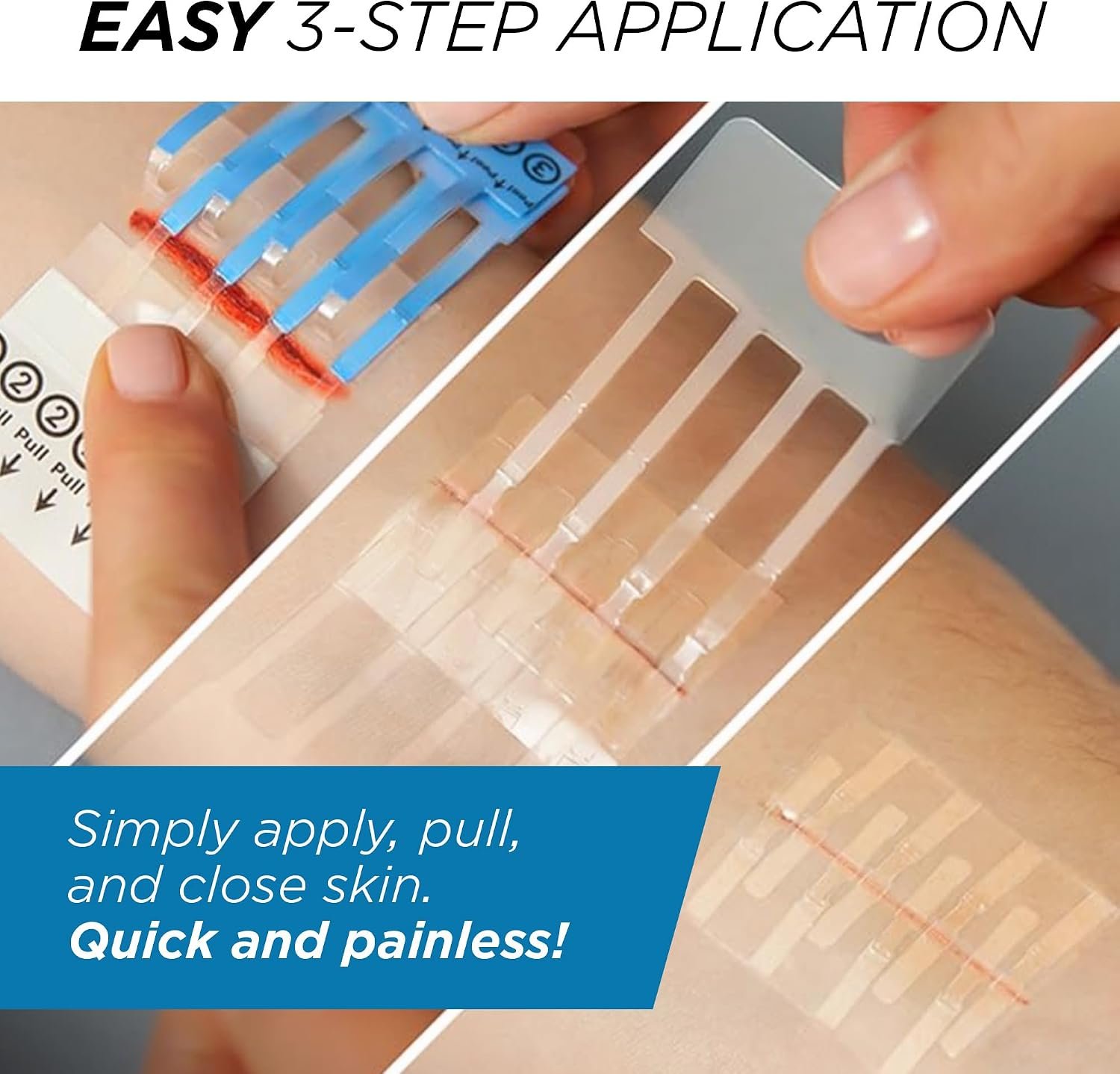 Clozex Emergency Laceration Kit - Repair Wounds Without Stitches, Skin Closure Device for a Wound Up to 1 1/2 Inches Length. Complete Kit to Clean, Close, & Cover Wounds - Image 5