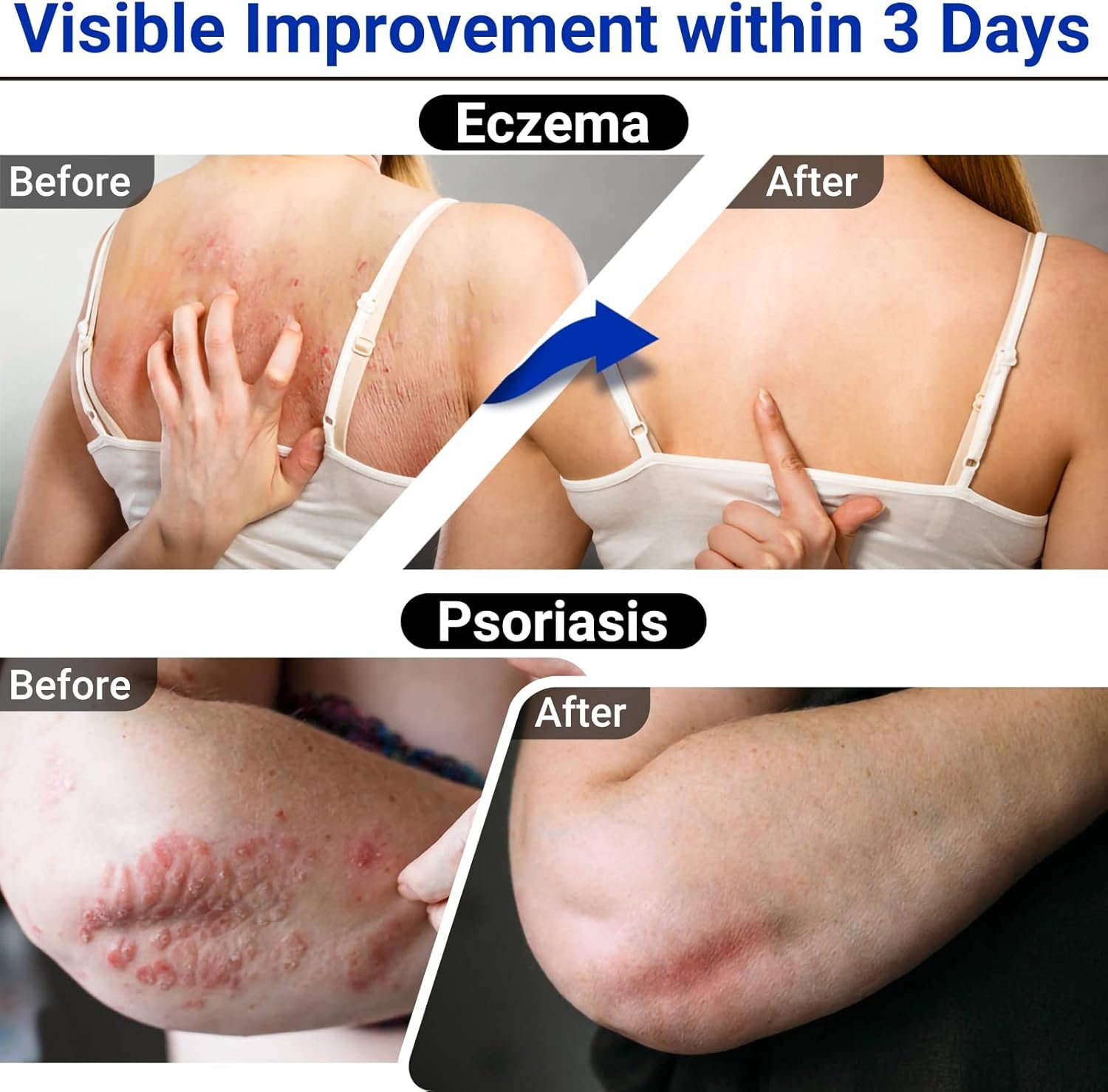 Eczema Cream, Maximum Strength Treatment Ointment for Rash, Psoriasis, Dermatitis, Urticaria, Jock Itch, Fungal Infection, Anti-Itch, Relief for Sensitive, Irritated Skin 1.76oz - Image 4