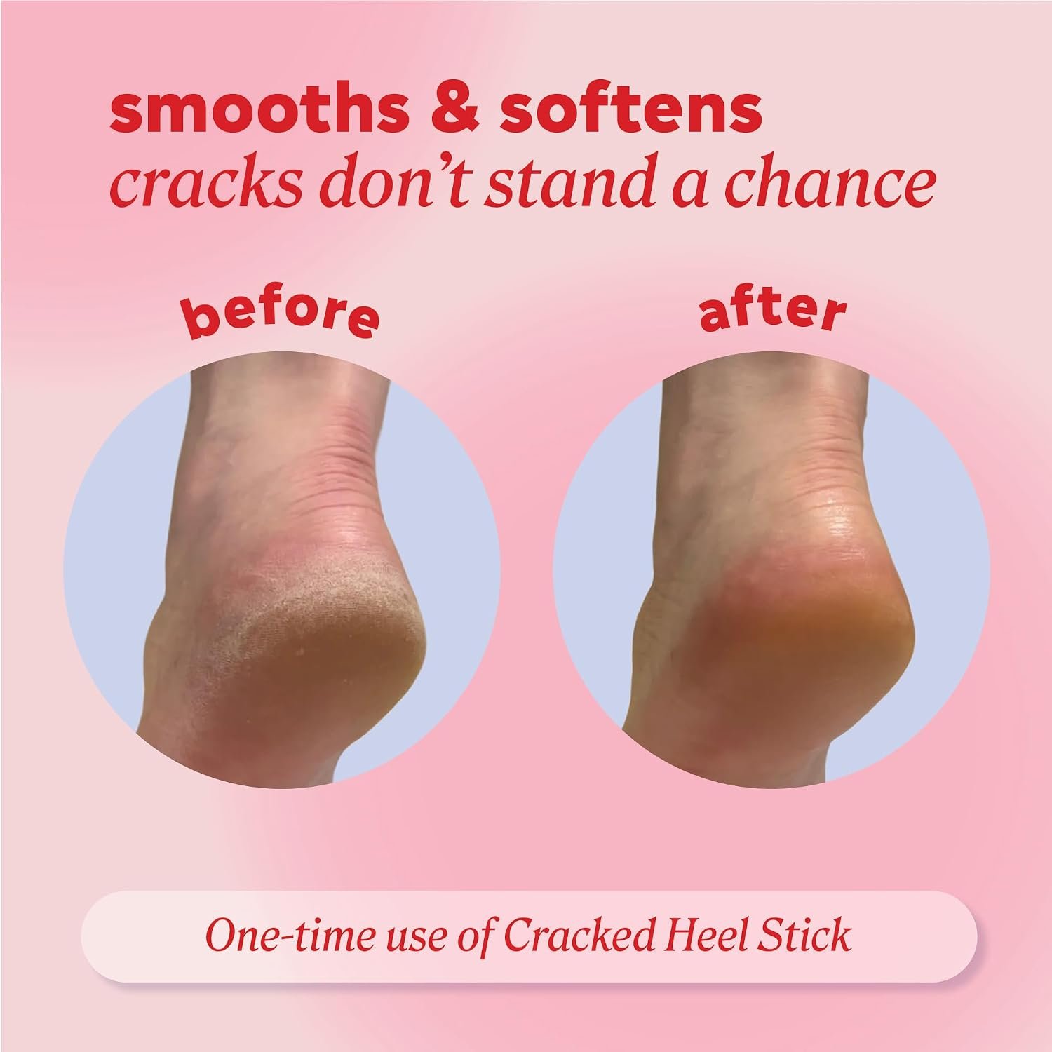 Onyx Professional Cracked Heel Treatment, Repairs Dry Heels, Coconut, 2 pk - Image 4