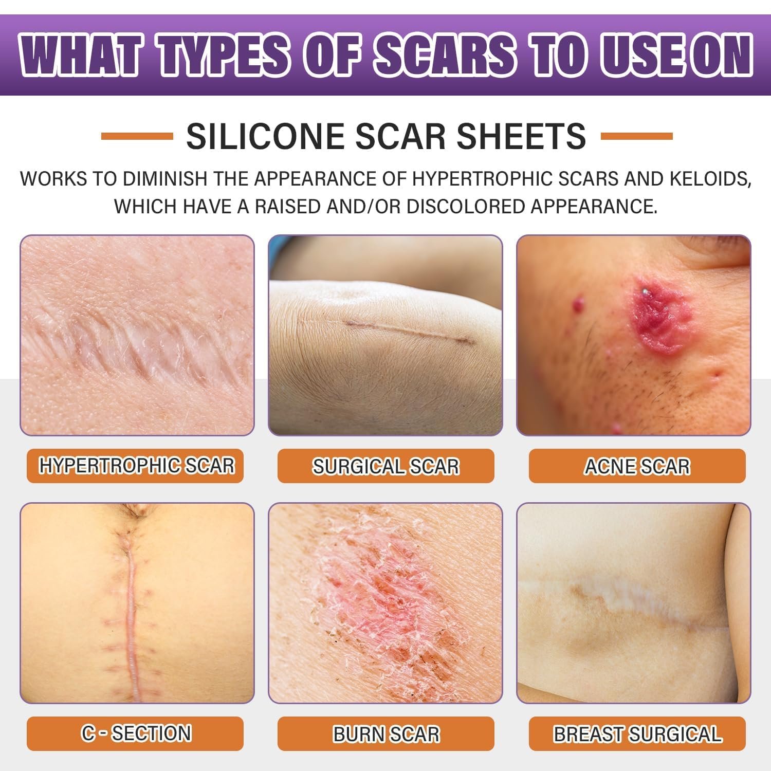 Silicone Scar Sheets, Medical Grade Silicone Scar Tape for Old & New Scars - Image 2